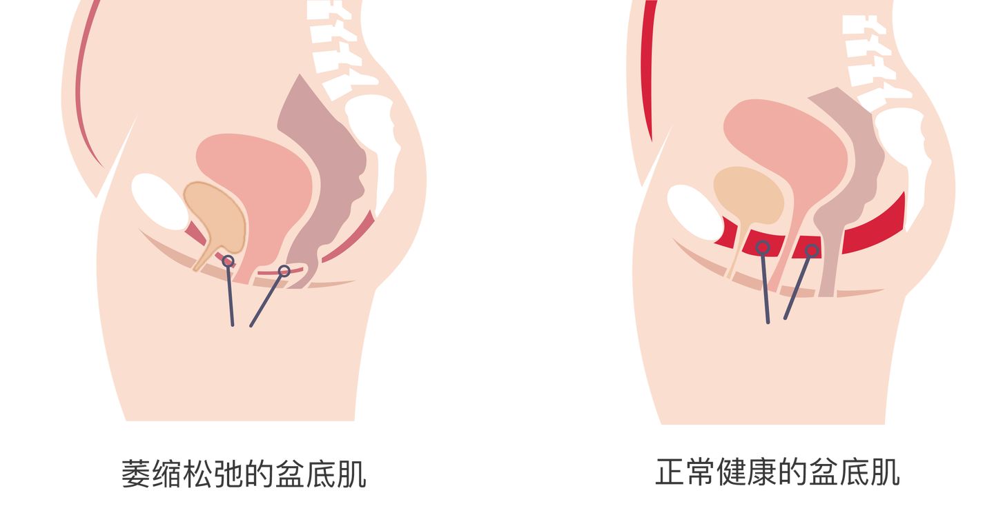 【瑜伽健身上新】【梦婷 盆底肌的强训治愈漏尿yin